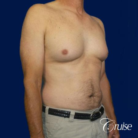 Moderate Gynecomastia Pedicle - Before and After Image 4