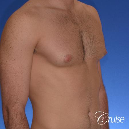 body builder with puffy nipples gets gyne surgery - Before Image 3