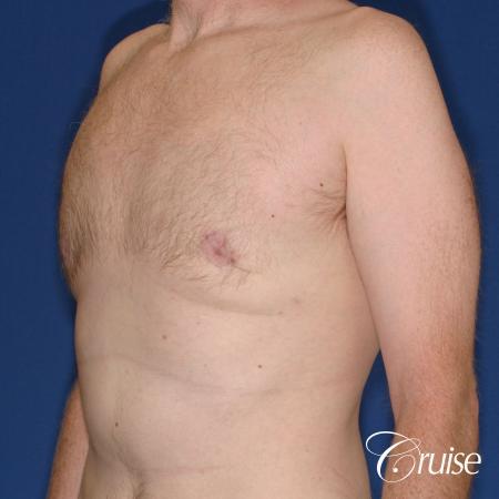 best donut lift with gynecomastia surgery - After Image 2