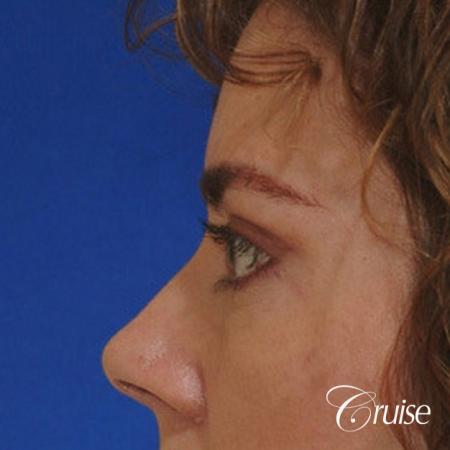 blepharoplasty specialist - After Image 2