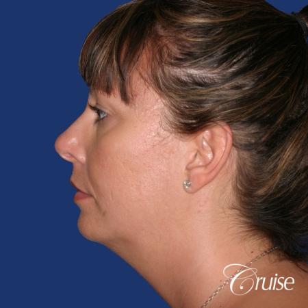 best before and after of chin augmentation medium implant - Before Image 2