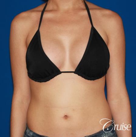 Breast Augmentation - After Image 4