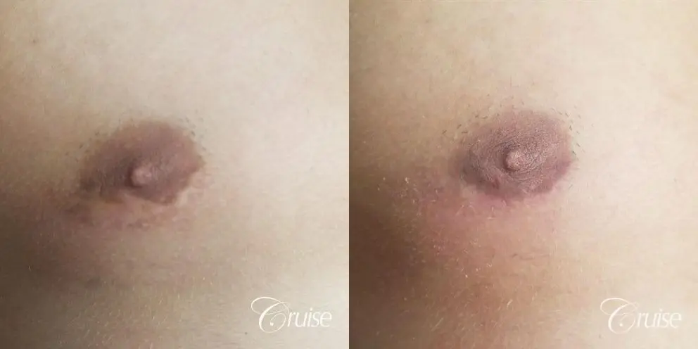 Medical Tattooing: Patient 1 - Before and After  