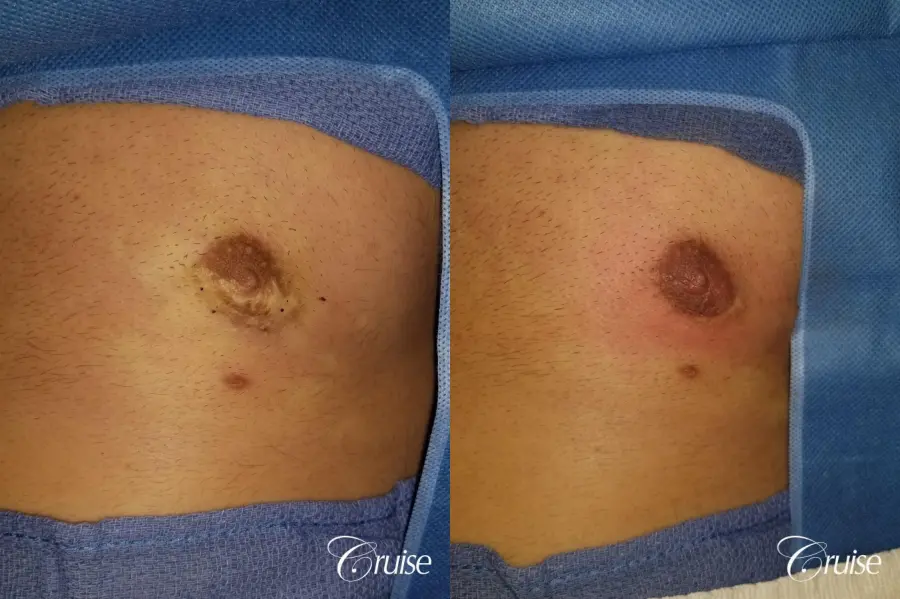 Medical Tattooing - Before and After  