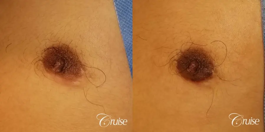 Medical Tattooing: Patient 4 - Before and After  
