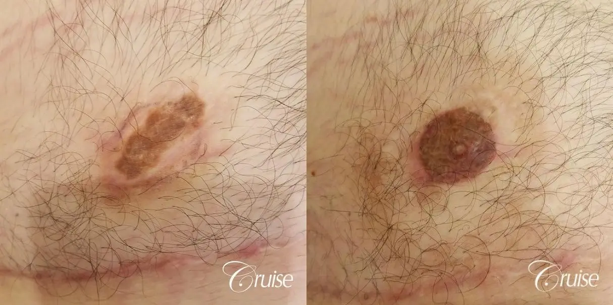 Medical Tattooing: Patient 4 - Before and After  