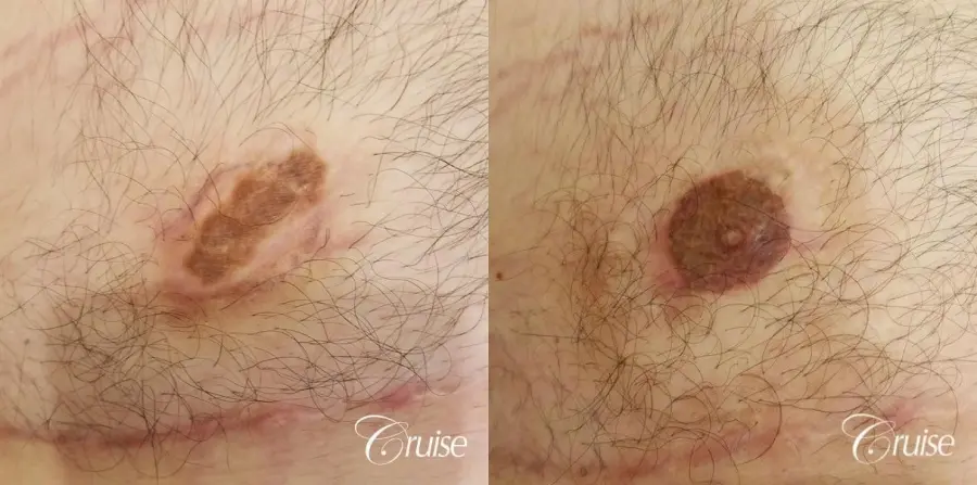 Medical Tattooing: Patient 3 - Before and After  
