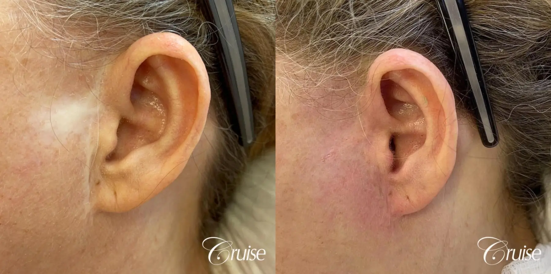Medical Tattooing: Patient 14 - Before and After 1