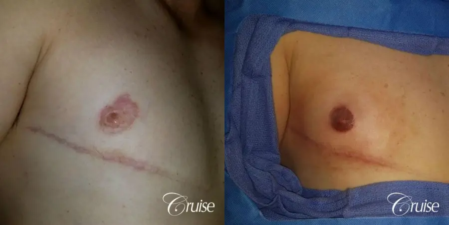 Medical Tattooing - Before and After 1
