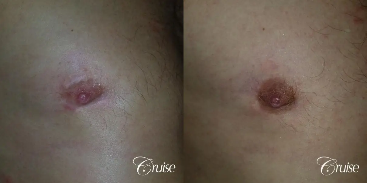 Medical Tattooing: Patient 7 - Before and After  