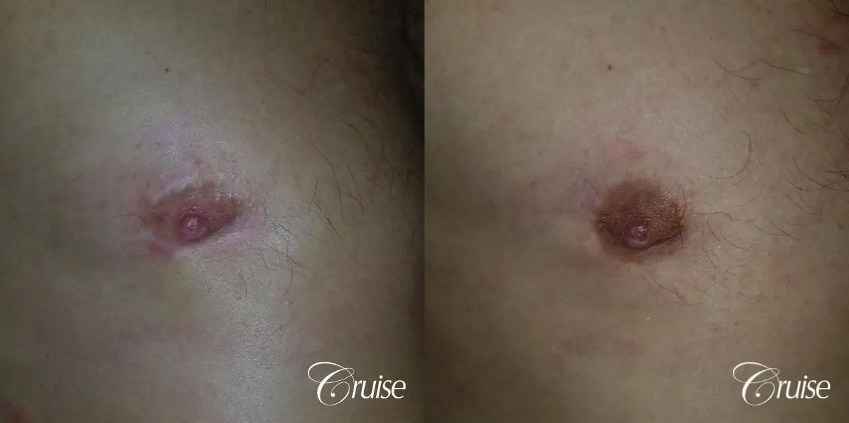 Medical Tattooing: Patient 8 - Before and After  