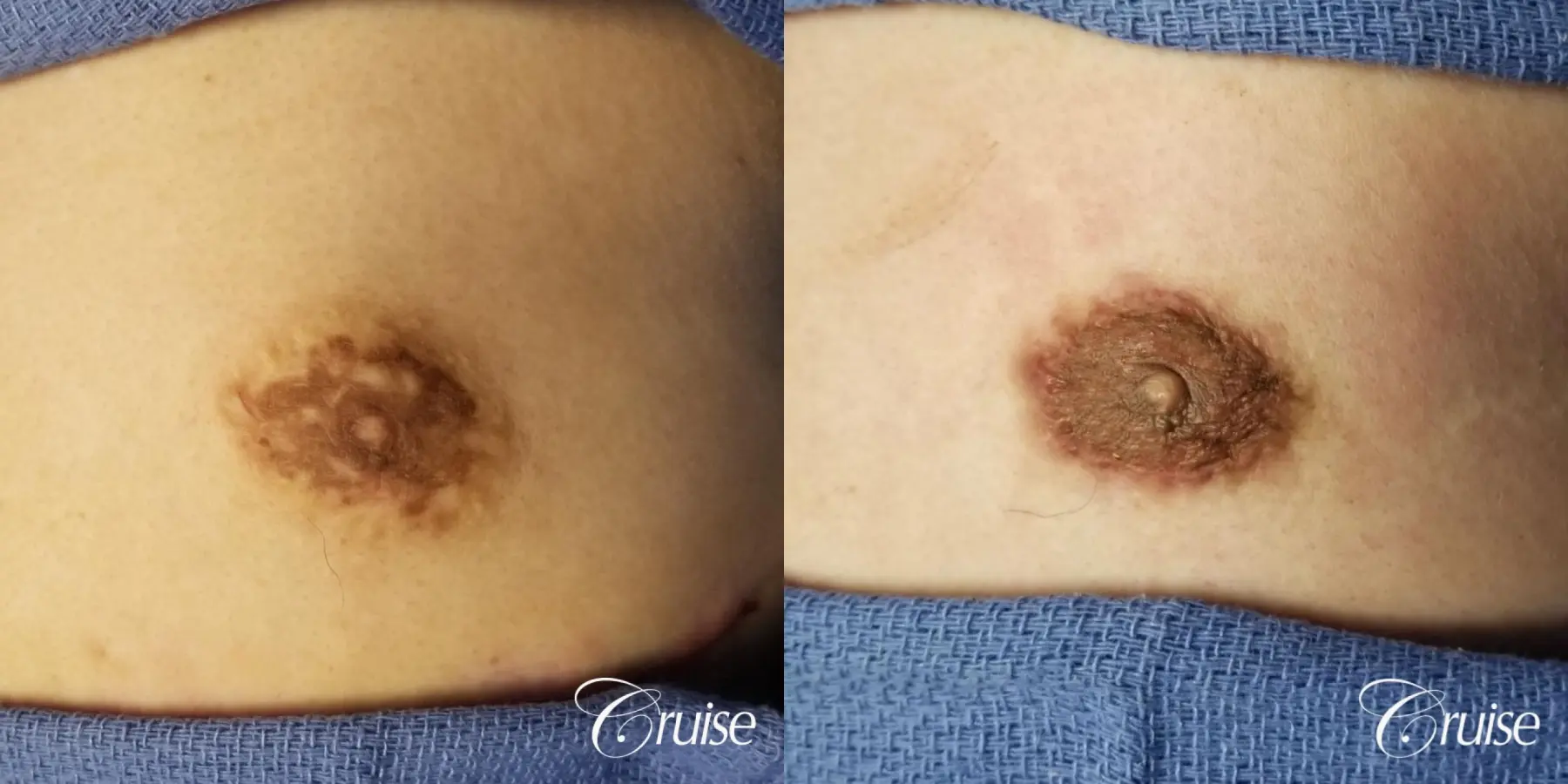 Medical Tattooing: Patient 2 - Before and After  