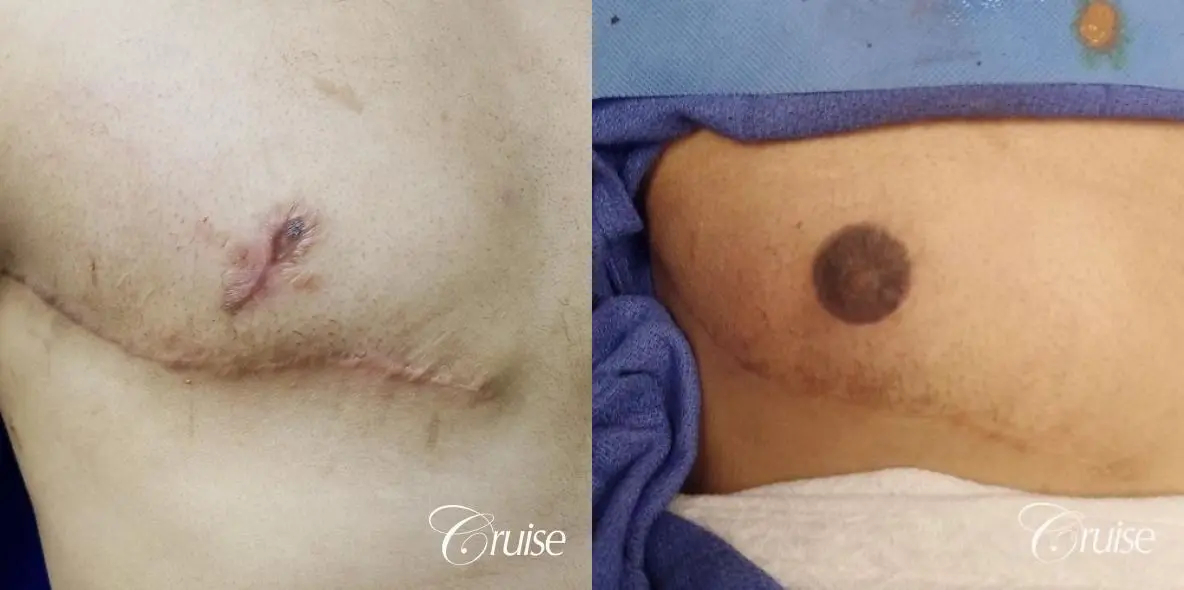Medical Tattooing: Patient 5 - Before and After  