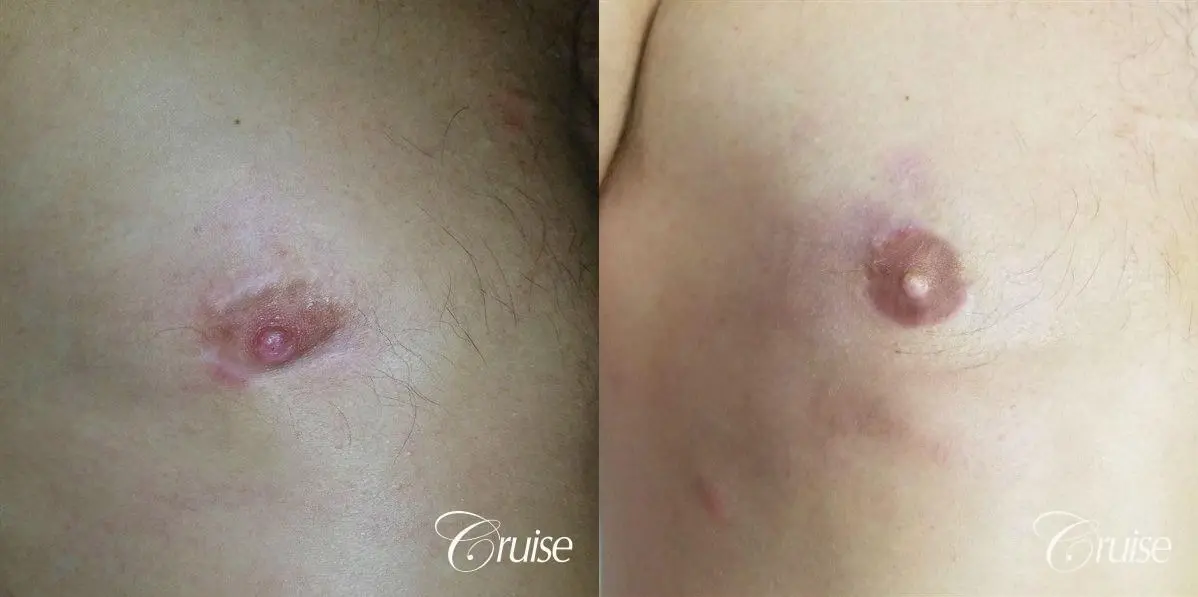 Medical Tattooing - Before and After 1
