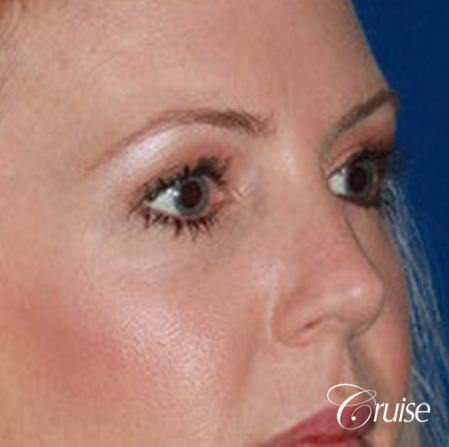best upper eye lid results - After Image 2