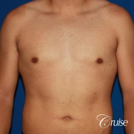 puffy nipple on 26 year old with gynecomastia - After Image 1