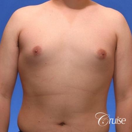 young male with mild gynecomastia surgery for puffy nipple - Before Image 1