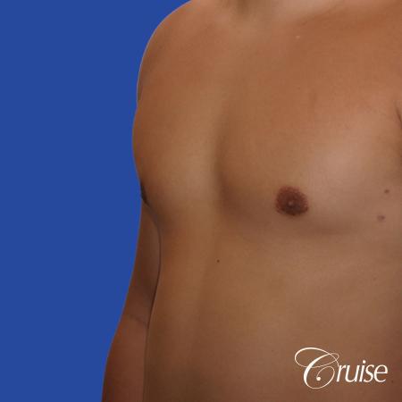 mild gynecomastia with puffy nipple and areola incision - After Image 2