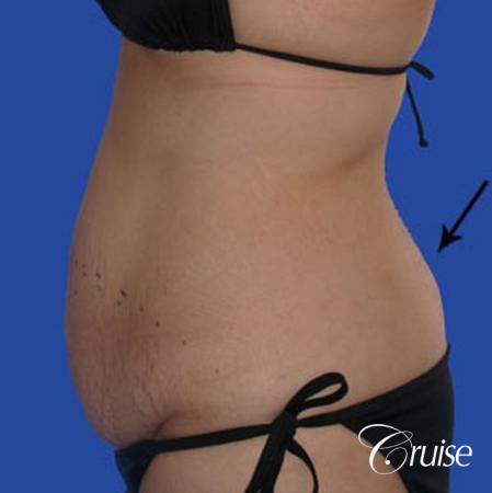 best liposuction tummy tuck - Before Image 2