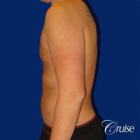 Best before and after lipo photos of guys - After Image 3