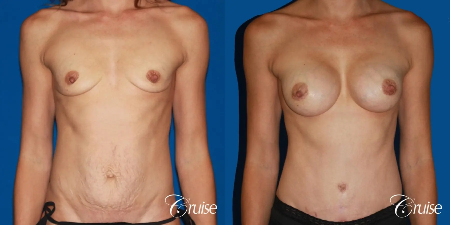 best ultra low tummy tuck scar with breast augmentation - Before and After 1
