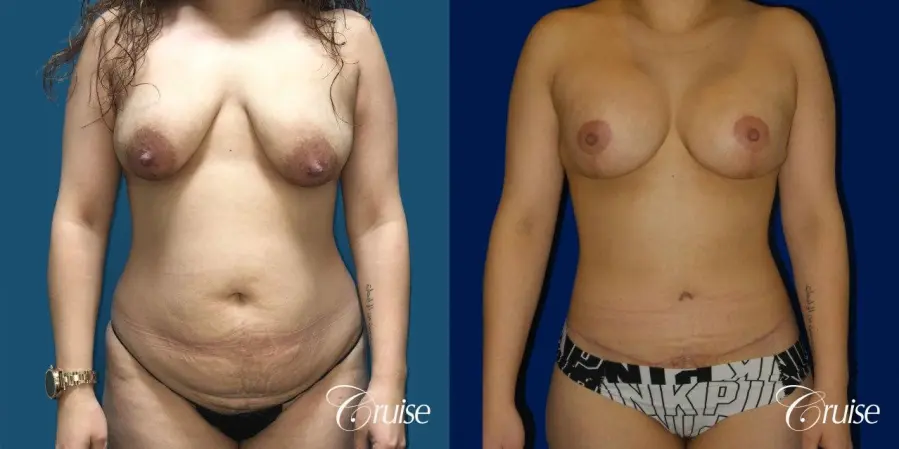 Extended Tummy Tuck, BBL, Breast Lift Anchor With Silicone - Before and After 1