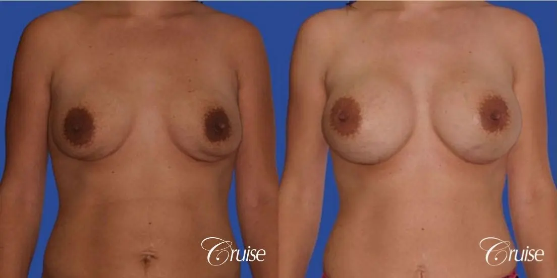 mini tummy tuck with silicone breast revision - Before and After 1