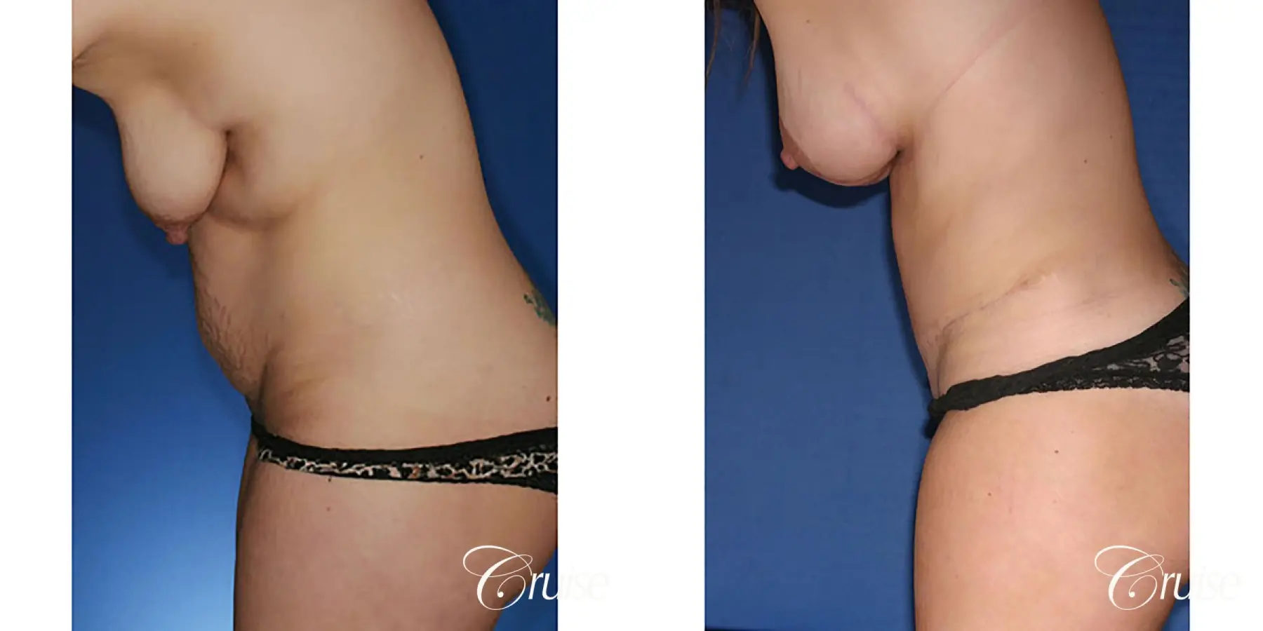 best mommy makeover with saline breast implants - Before and After 3