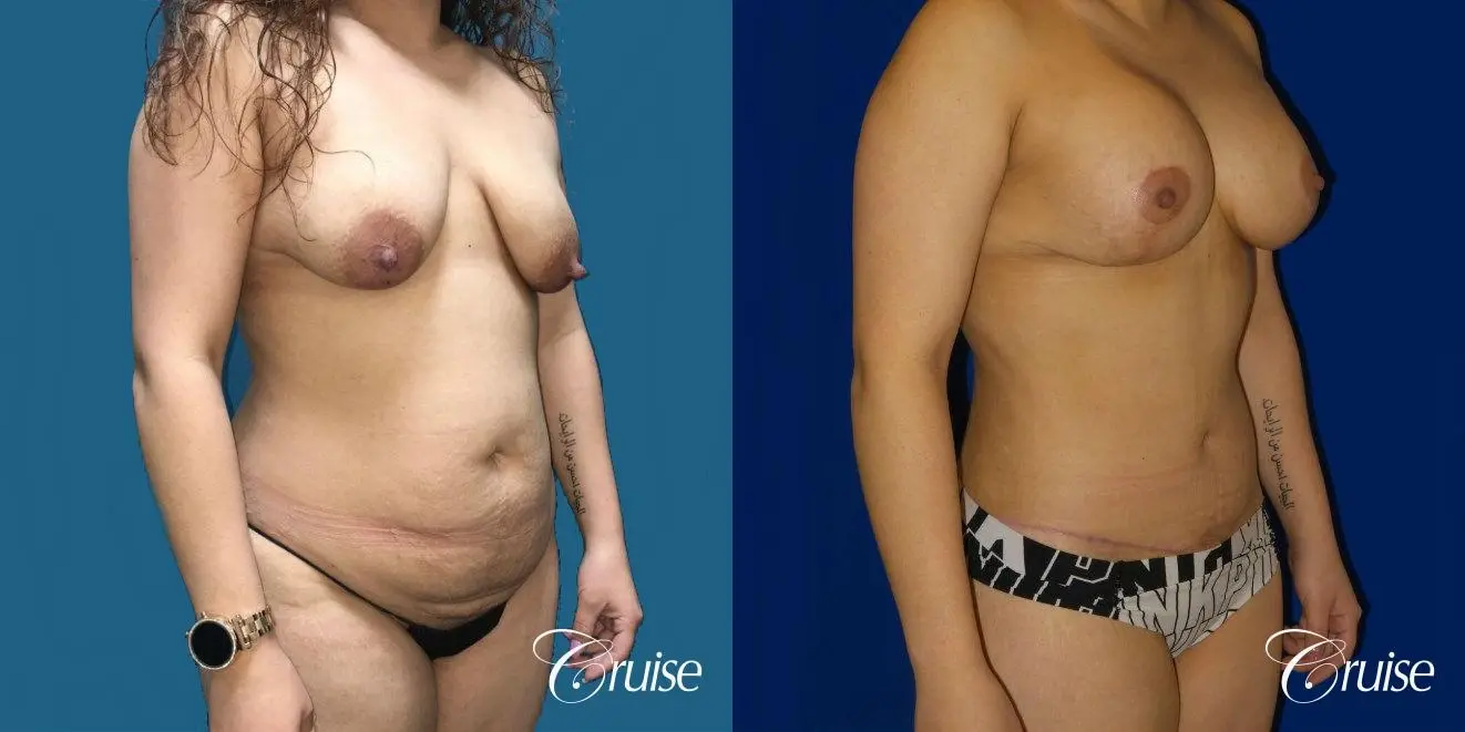 Extended Tummy Tuck, BBL, Breast Lift Anchor With Silicone - Before and After 3