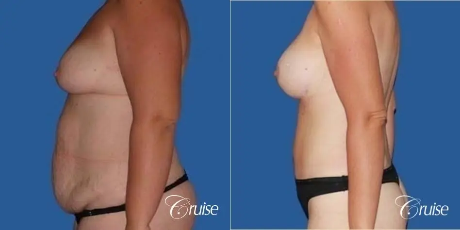best mommy make over scars on massive weight loss silicone - Before and After 2