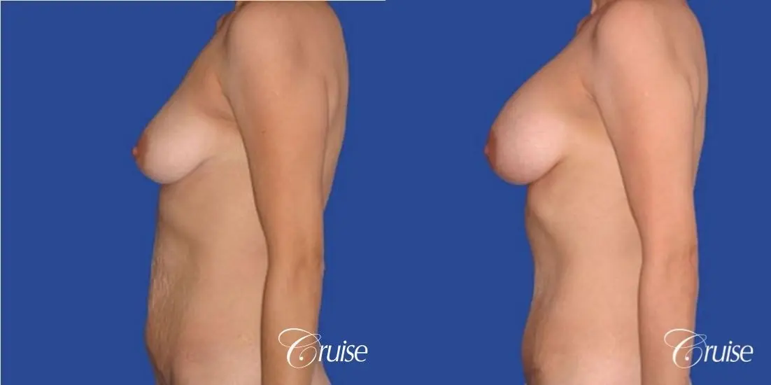best mommy makeover incisions with saline implants - Before and After 2