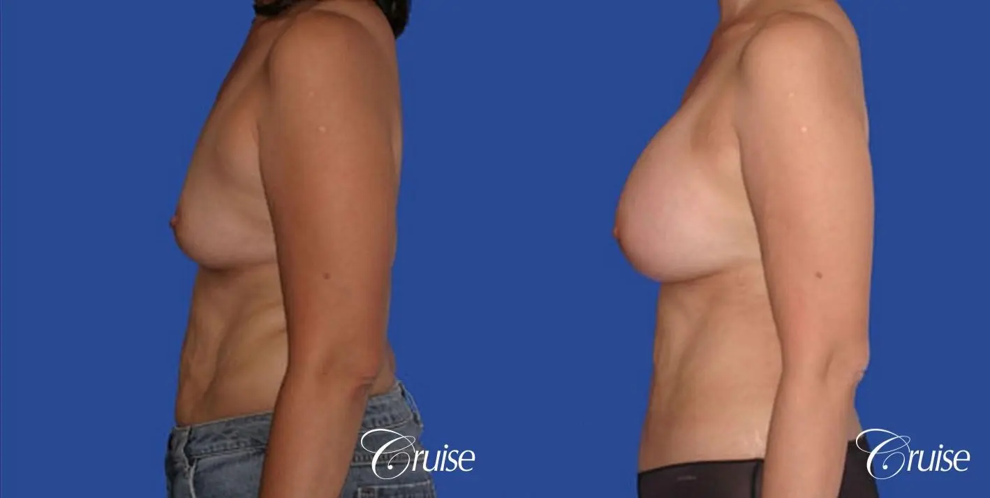 best mini mommy makeover with silicone breast implants - Before and After 2