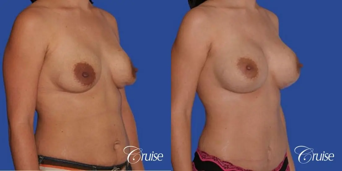 mini tummy tuck with silicone breast revision - Before and After 3