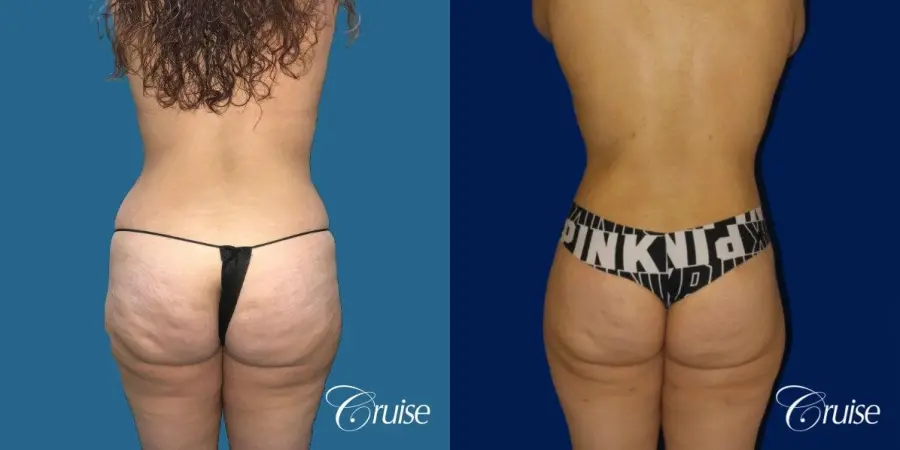 Extended Tummy Tuck, BBL, Breast Lift Anchor With Silicone - Before and After 4