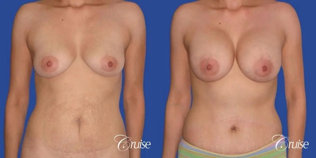 best mommy makeover incisions with saline implants - Before and After 1