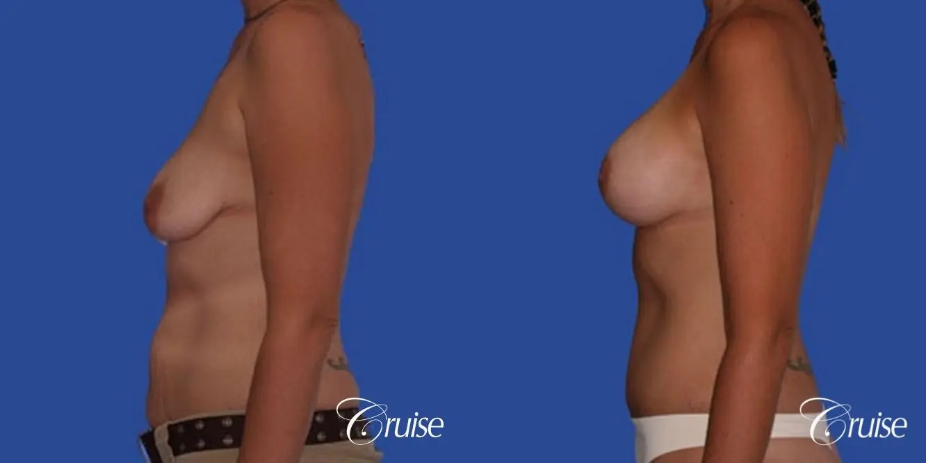 best scar for mommy make over breast lift tummy tuck - Before and After 2