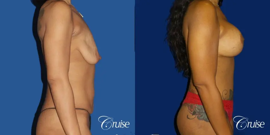 Standard Tummy Tuck, Breast Lift Anchor With Silicone - Before and After 3