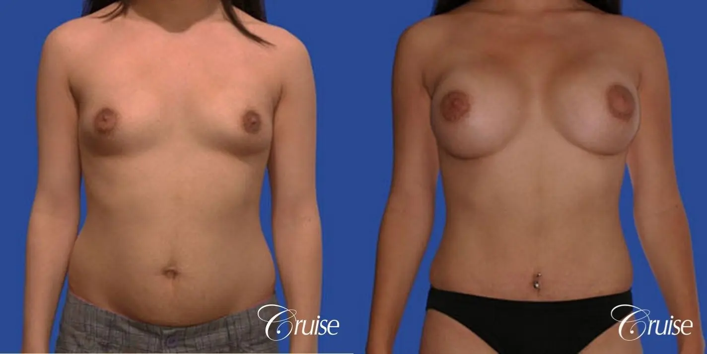 best pictures of low mini tuck and breast augmentation Newport Beach - Before and After 1