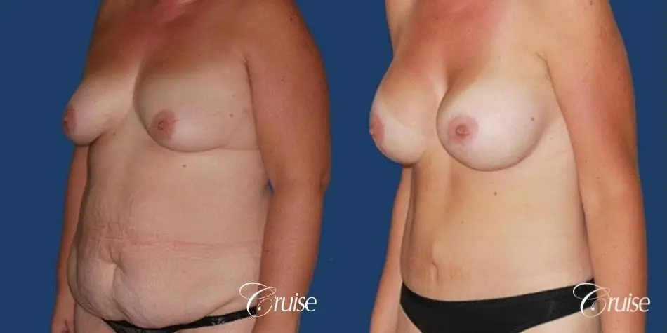 best mommy make over scars on massive weight loss silicone - Before and After 3