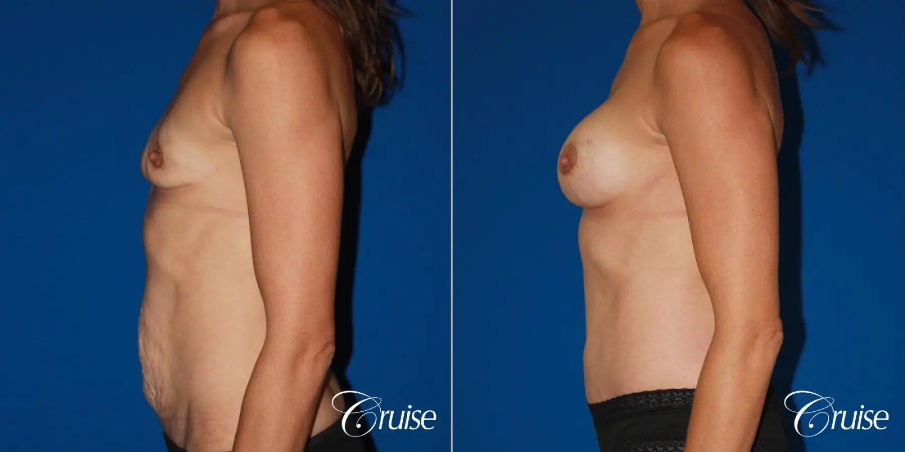 best ultra low tummy tuck scar with breast augmentation - Before and After 2