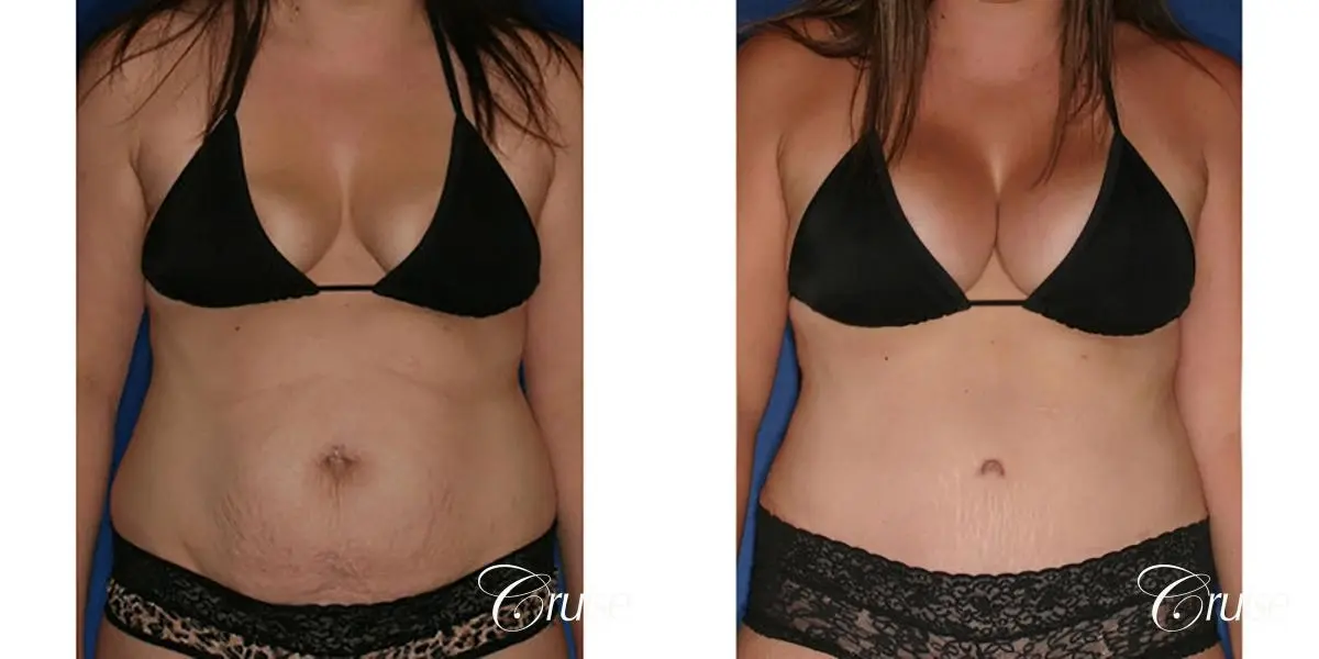 best mommy makeover with saline breast implants - Before and After 5
