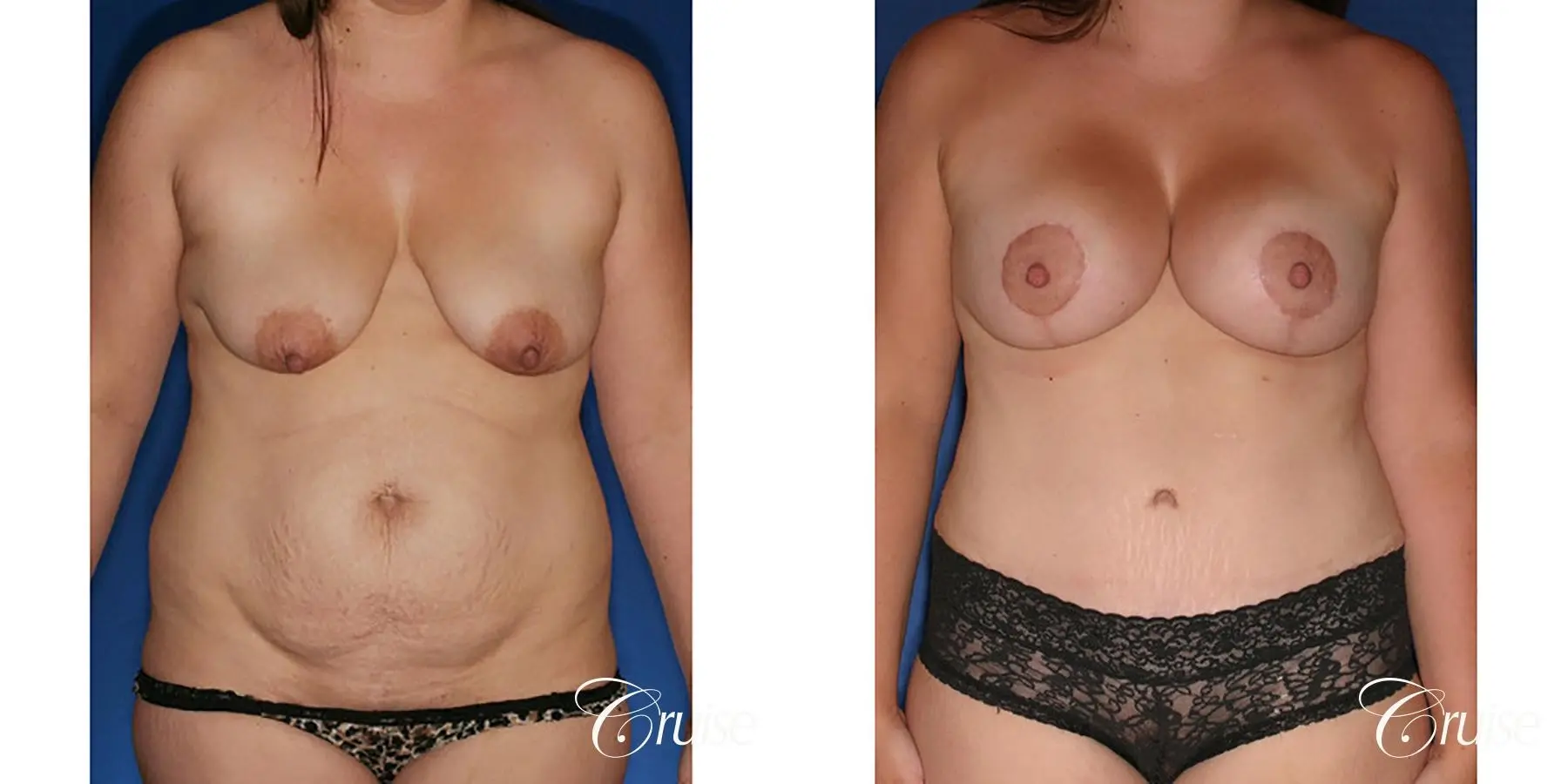 best mommy makeover with saline breast implants - Before and After 1