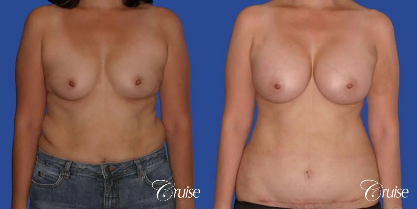 best mini mommy makeover with silicone breast implants - Before and After 1