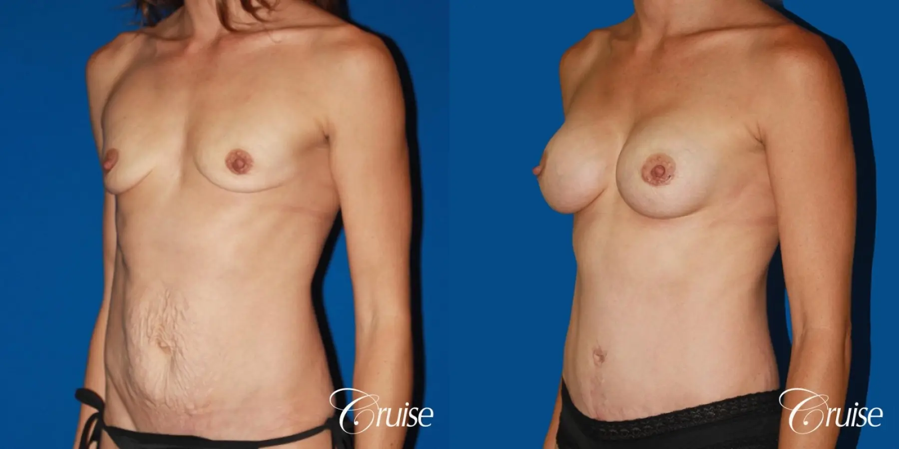 best ultra low tummy tuck scar with breast augmentation - Before and After 3