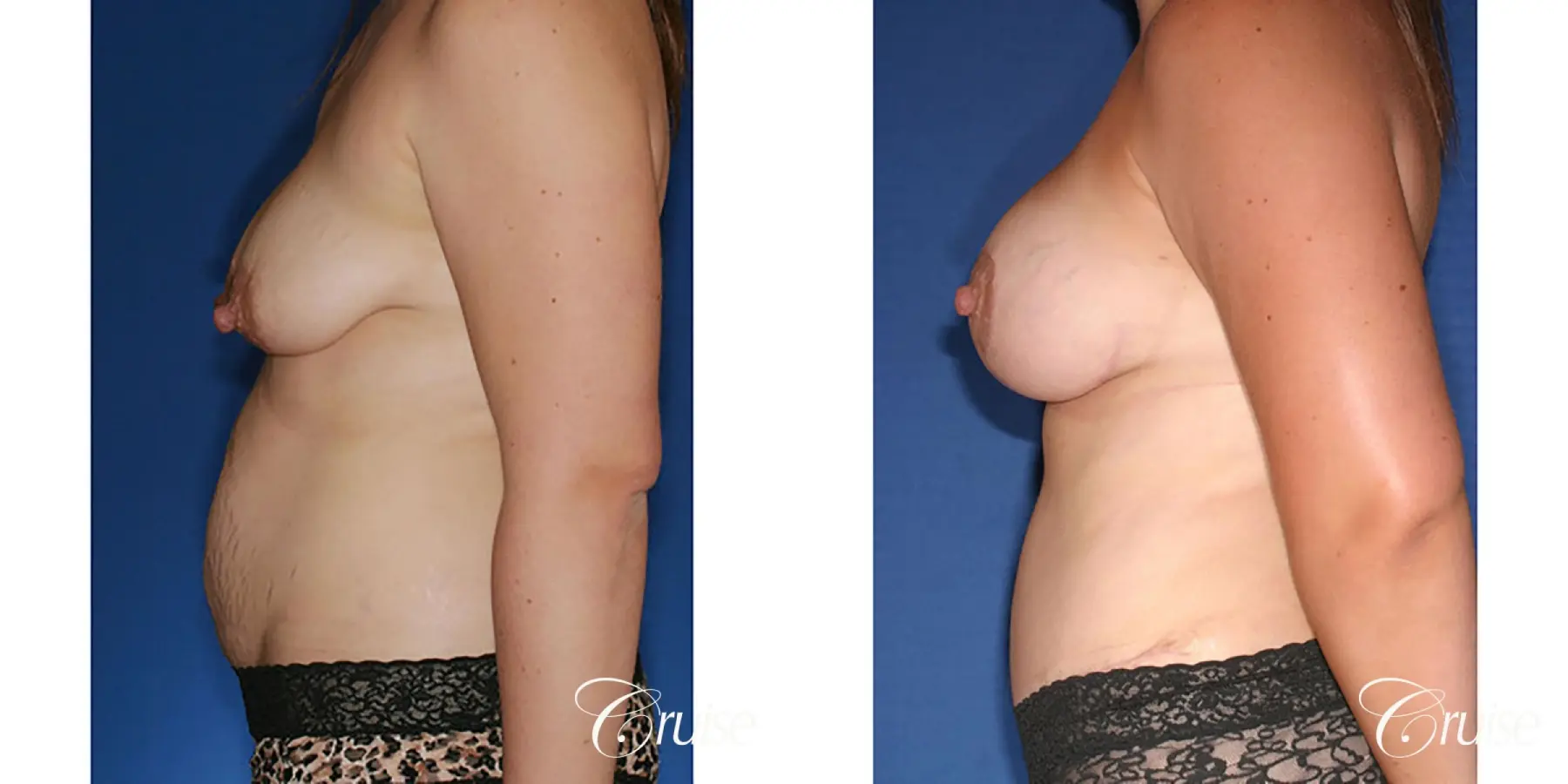 best mommy makeover with saline breast implants - Before and After 2