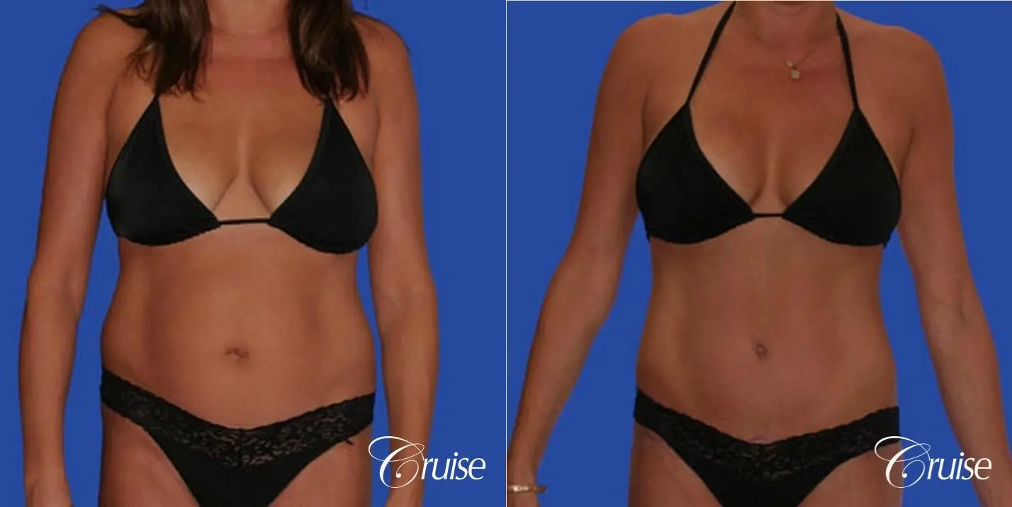 mommy makeover with best breast lift anchor with saline implants - Before and After 4