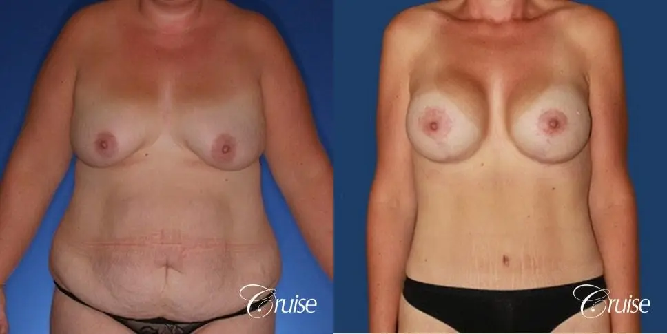 best mommy make over scars on massive weight loss silicone - Before and After 1