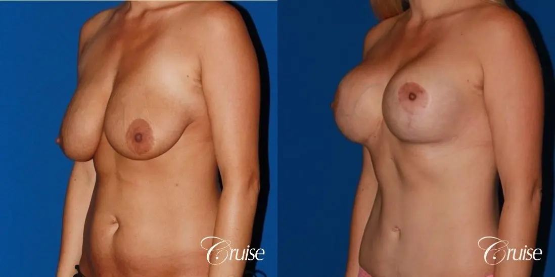 tummy tuck and saline breast lift with large implants on mommy makeover - Before and After 3
