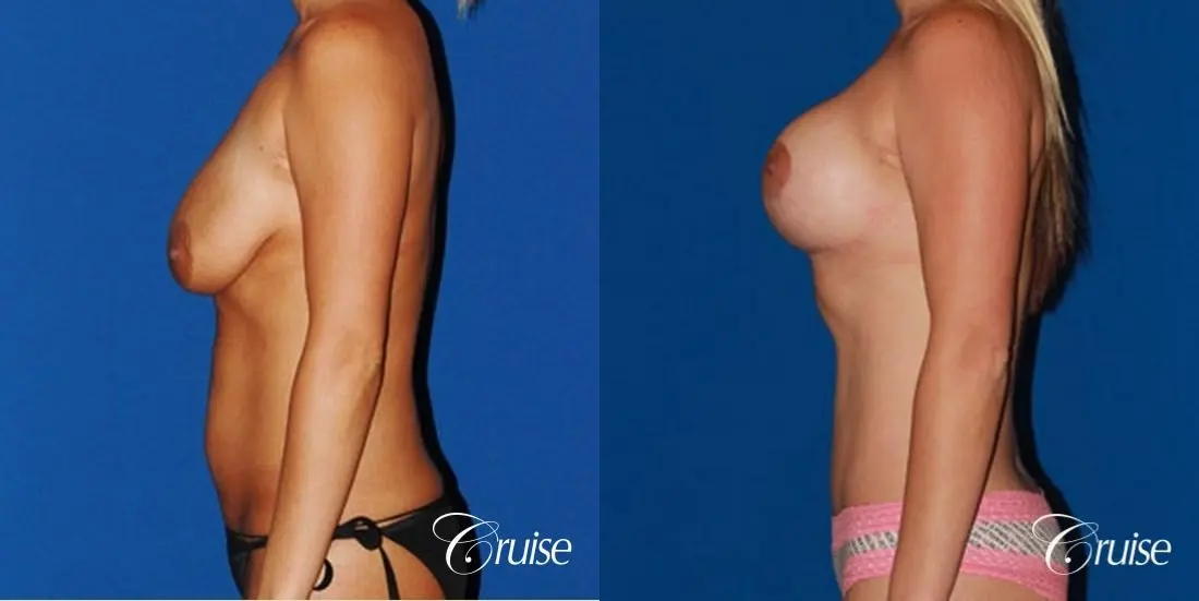 tummy tuck and saline breast lift with large implants on mommy makeover - Before and After 2