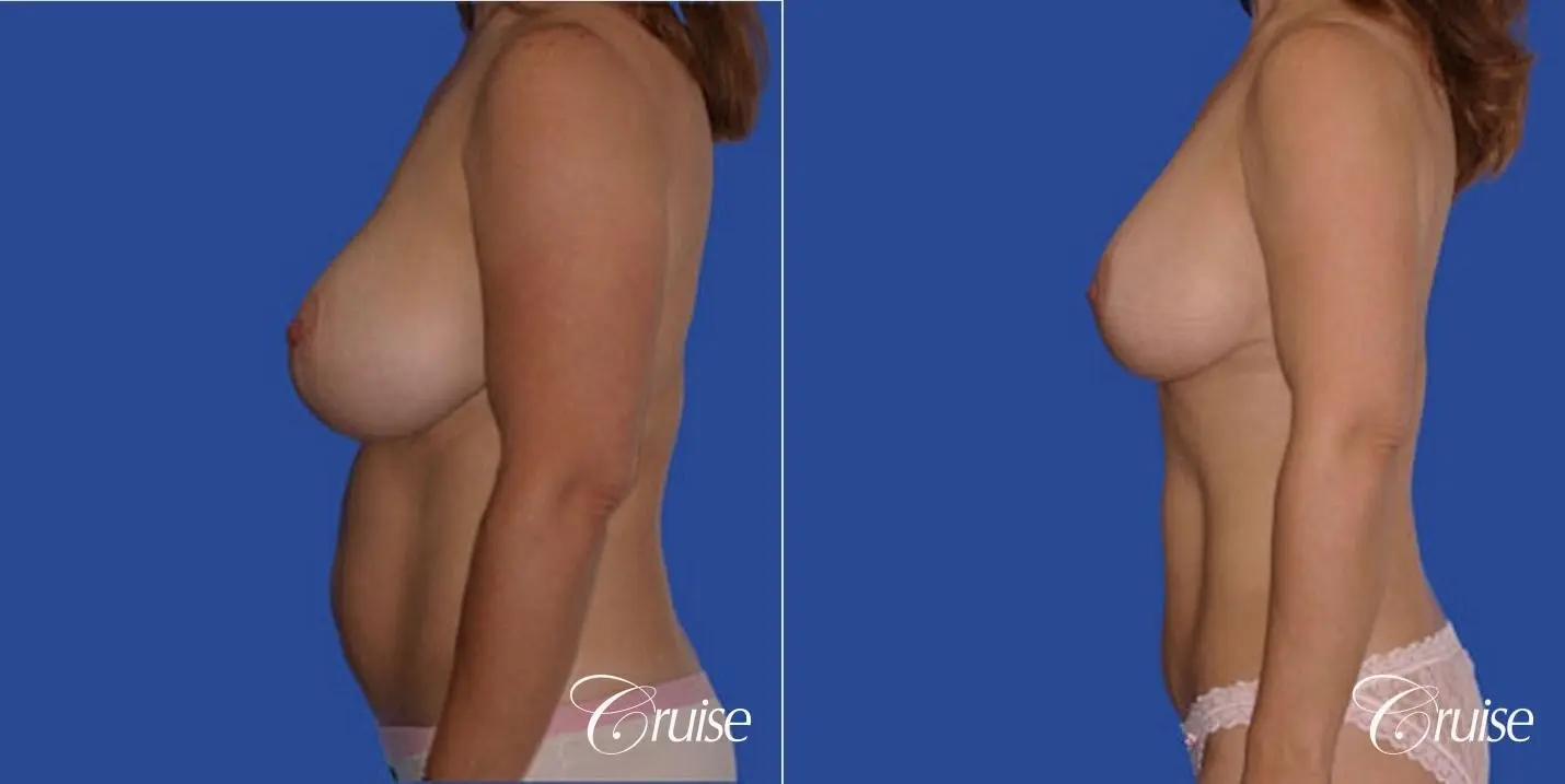 best breast revision tummy tuck mommy make over - Before and After 2